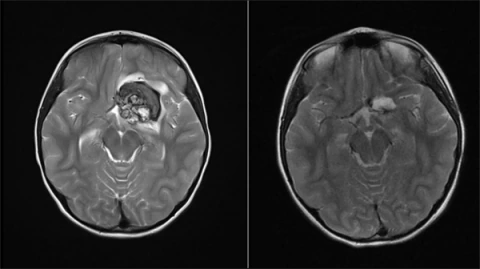 Child with a brain tumor
