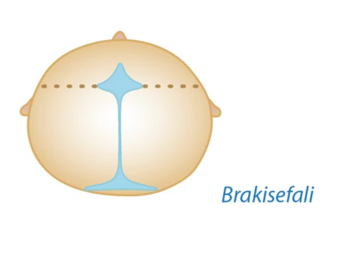 Brakisefali — bikoronal sinostoz kraniyosinostoz tipi şeması