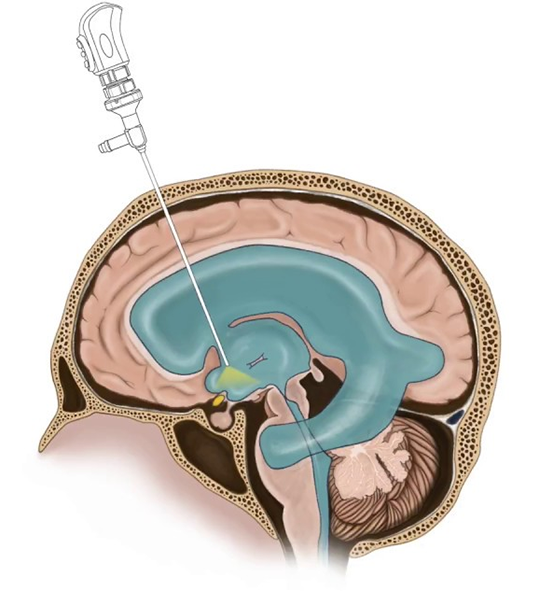 endoscopic ventriculostomy