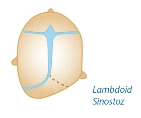 Lambdoid sinostoz — posterior plagiosefali kraniyosinostoz tipi şeması