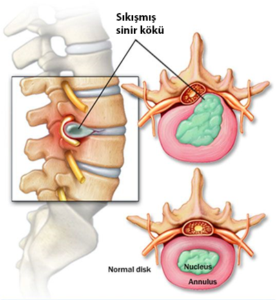 Lumbar Disc