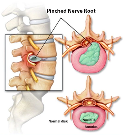 Lumbar Disc