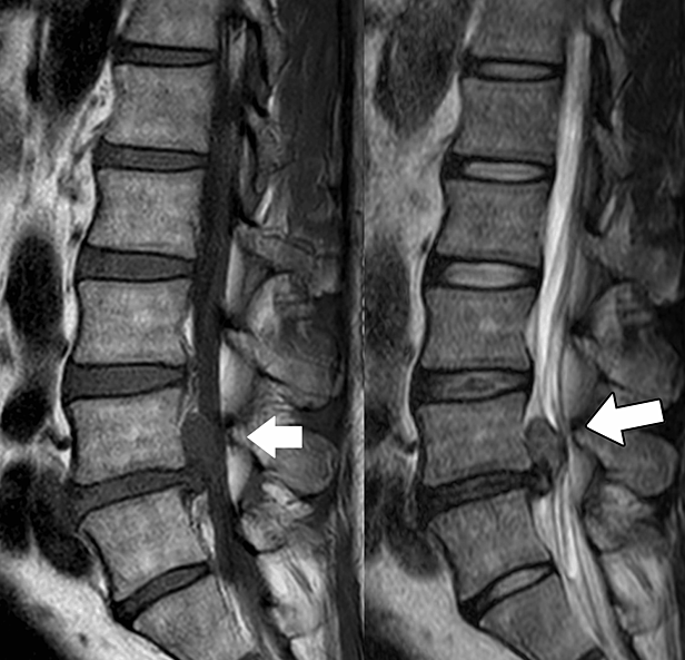 Lumbar Disc MRI