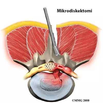 Mikrodiskektomi