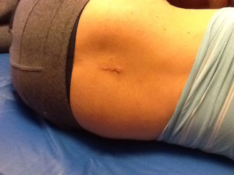 Lumbar disc surgery incision