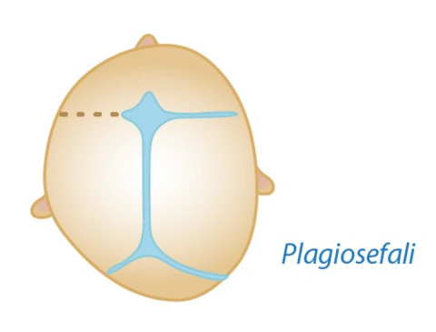 Plagiosefali — unikoronal sinostoz kraniyosinostoz tipi şeması