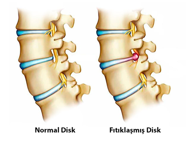 Servikal Disk
