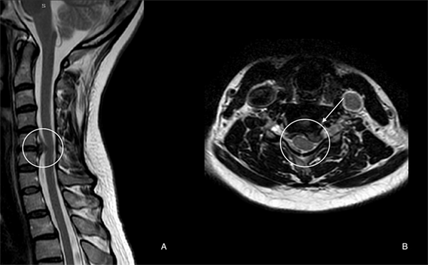Boyun Fıtığı MRI