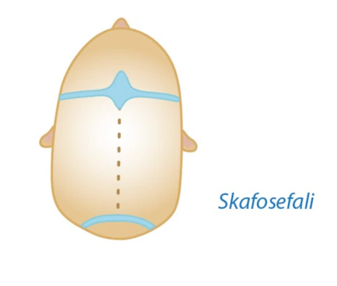 Skafosefali — sagital sinostoz kraniyosinostoz tipi şeması