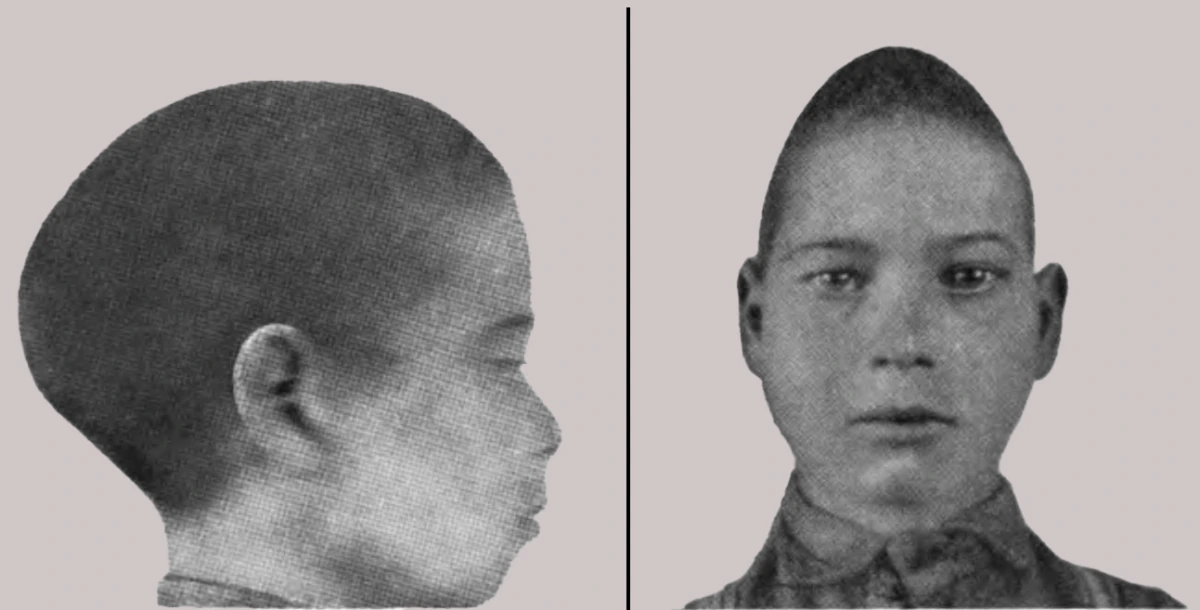 Skafosefali — sagital sinostoz örnek görüntü
