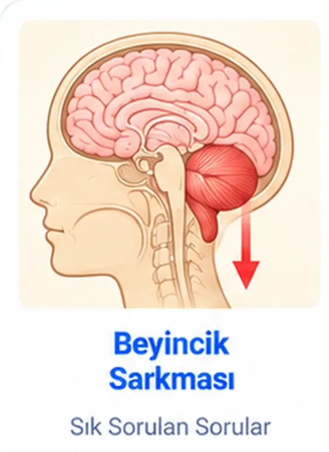 Chiari malformation (Arnold-Chiari malformation) informational graphic