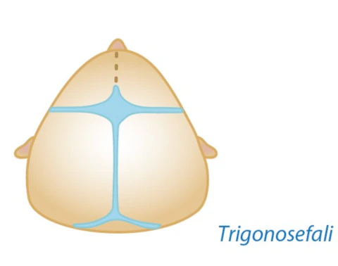 Trigonosefali — metopik sinostoz kraniyosinostoz tipi şeması