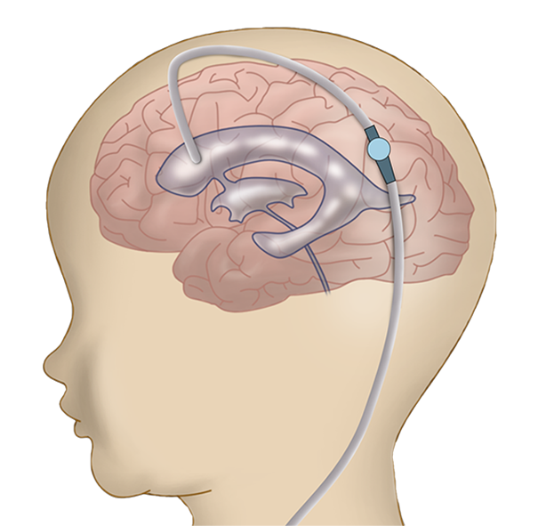 ventriculoperitoneal shunt