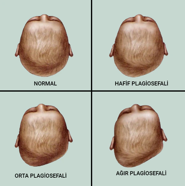 plagiocephaly in Infants — Comparison of Normal, Mild, Moderate, and Severe Head Shapes